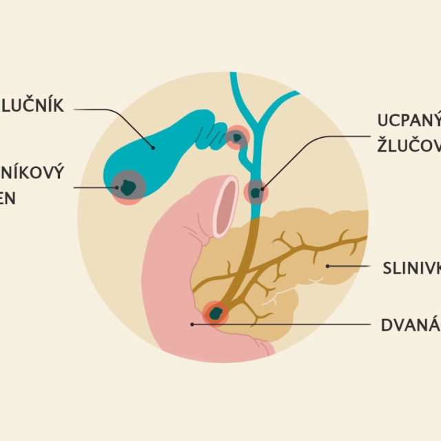 Jak pročistit žlučovody